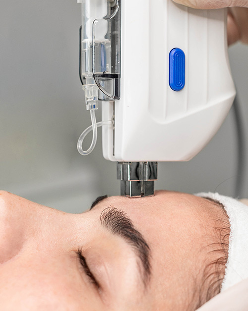 MesoBoost tretman za pomlađivanje kože bez igle